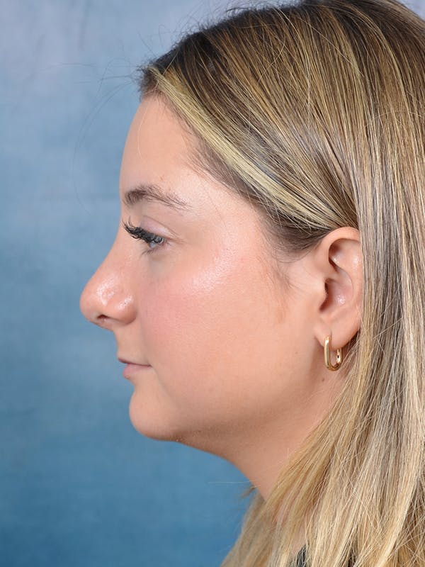 Rhinoplasty Before & After Gallery - Patient 144210399 - Image 2