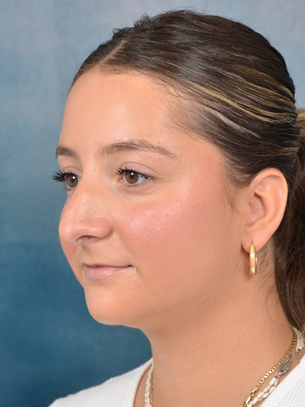 Rhinoplasty Before & After Gallery - Patient 144210399 - Image 5