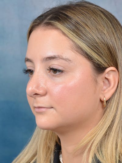 Rhinoplasty Before & After Gallery - Patient 144210399 - Image 6