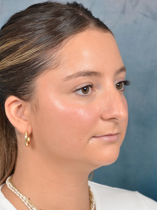 Rhinoplasty Before & After Gallery - Patient 144210399 - Image 7