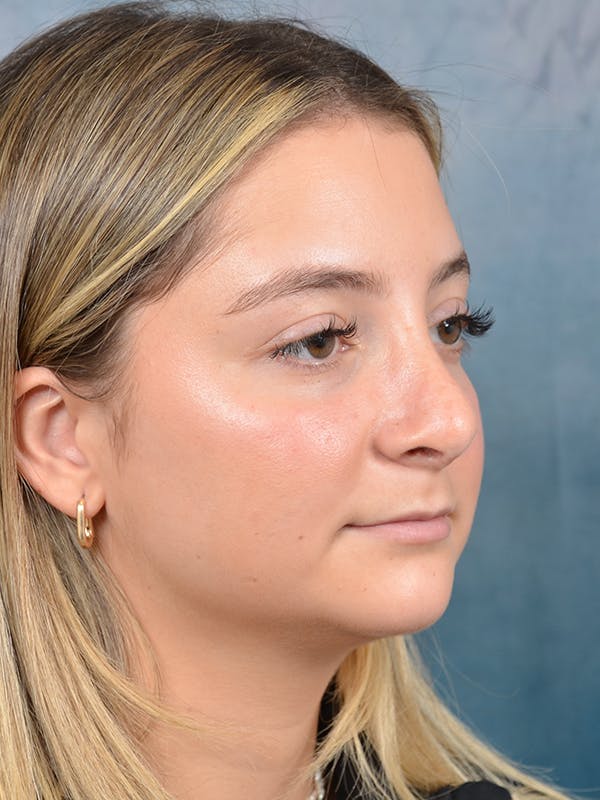Rhinoplasty Before & After Gallery - Patient 144210399 - Image 8