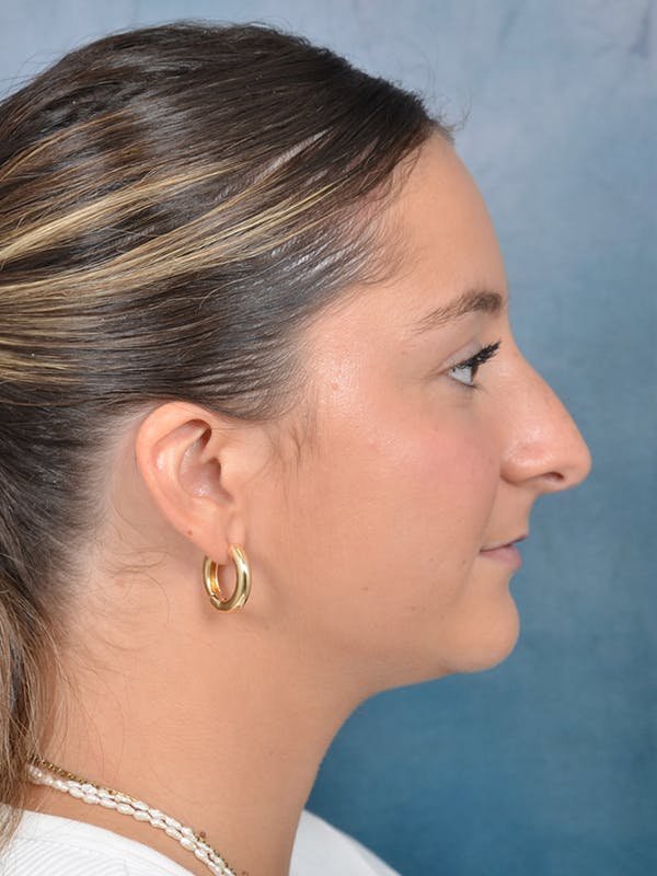 Rhinoplasty Before & After Gallery - Patient 144210399 - Image 9