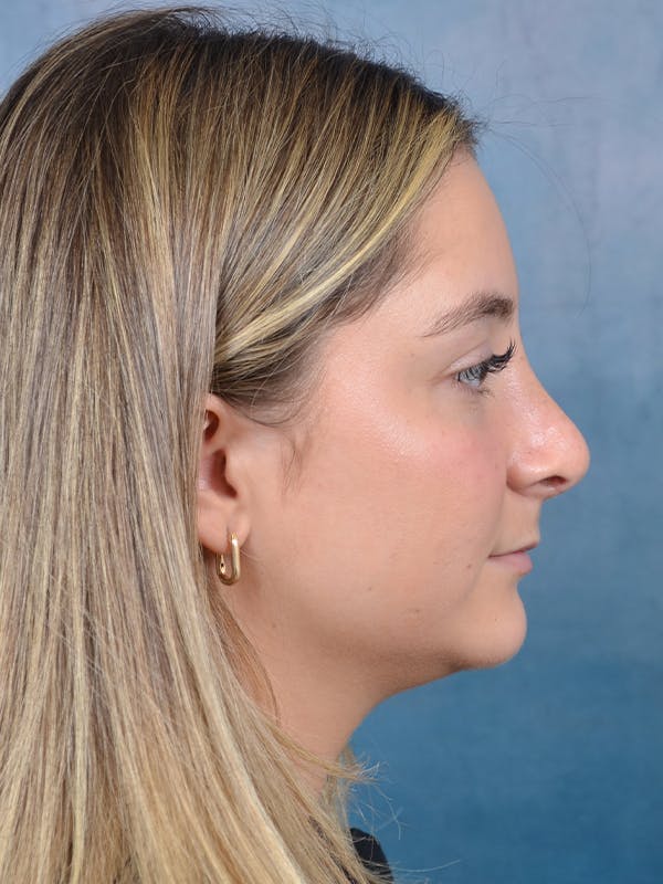 Rhinoplasty Before & After Gallery - Patient 144210399 - Image 10