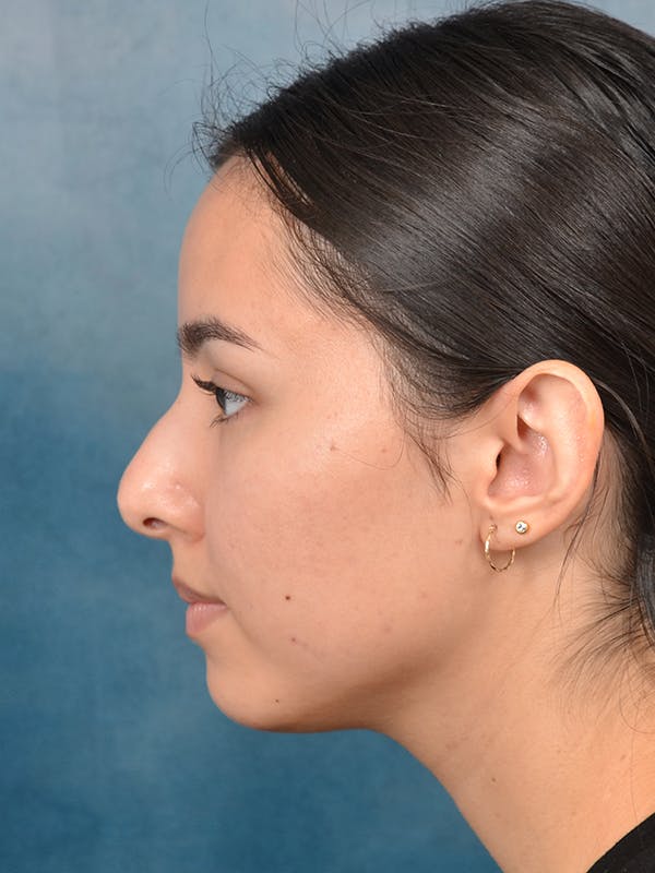 Rhinoplasty Before & After Gallery - Patient 144210400 - Image 1