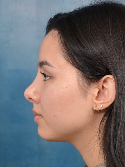 Rhinoplasty Before & After Gallery - Patient 144210400 - Image 2