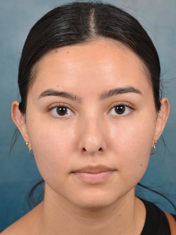 Rhinoplasty Before & After Gallery - Patient 144210400 - Image 3