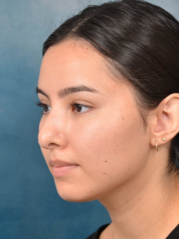 Rhinoplasty Before & After Gallery - Patient 144210400 - Image 5