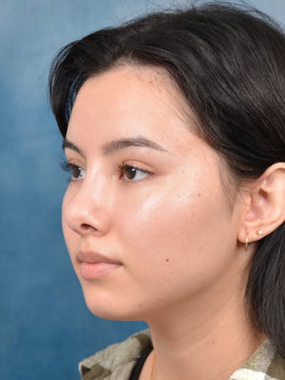 Rhinoplasty Before & After Gallery - Patient 144210400 - Image 6