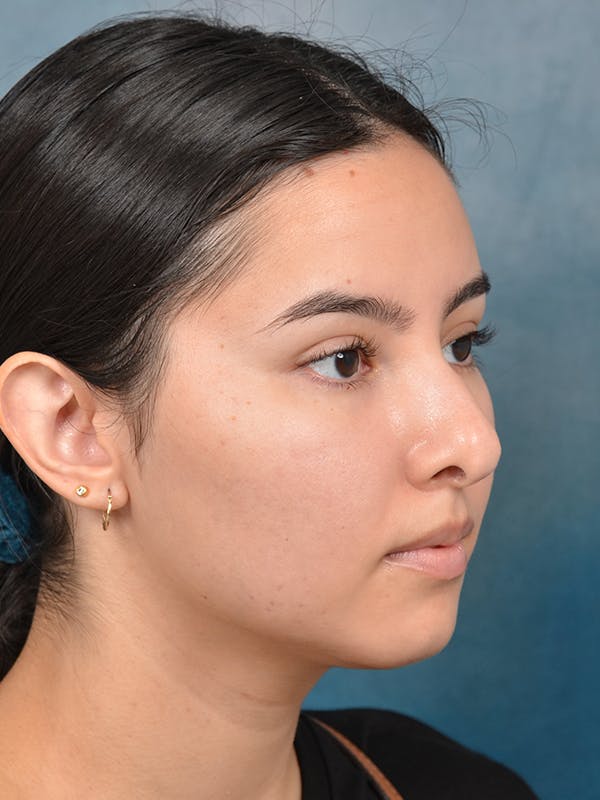 Rhinoplasty Before & After Gallery - Patient 144210400 - Image 7