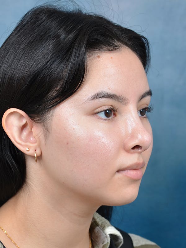 Rhinoplasty Before & After Gallery - Patient 144210400 - Image 8