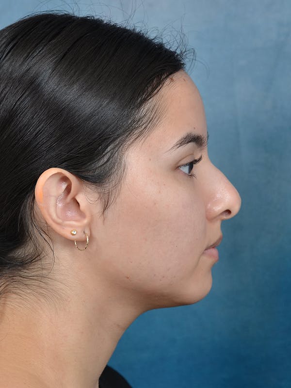Rhinoplasty Before & After Gallery - Patient 144210400 - Image 9