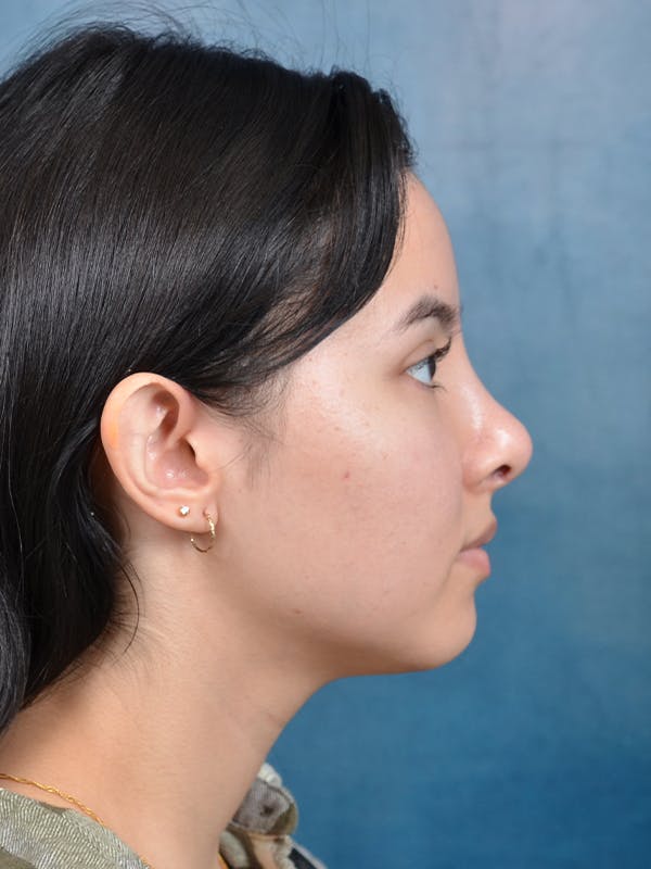 Rhinoplasty Before & After Gallery - Patient 144210400 - Image 10