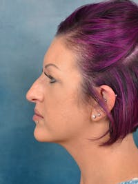 Rhinoplasty Before & After Gallery - Patient 144210401 - Image 1