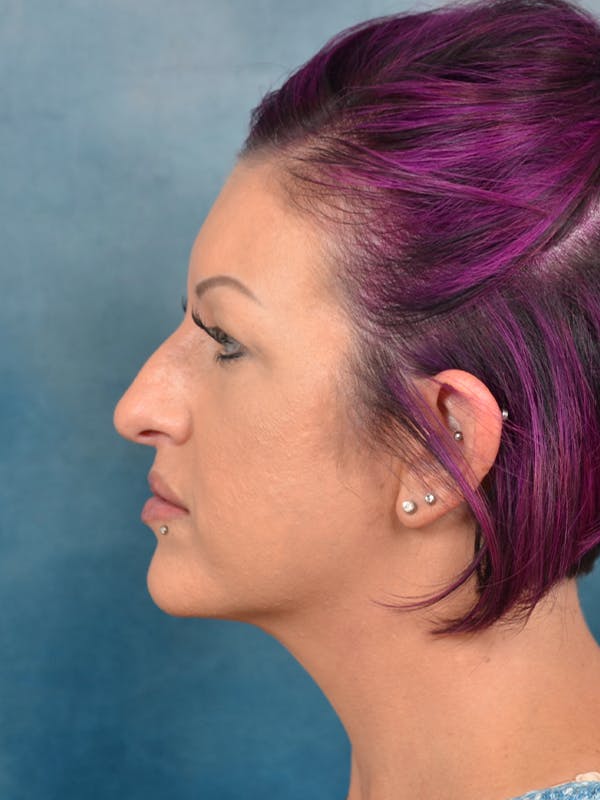 Rhinoplasty Before & After Gallery - Patient 144210401 - Image 1