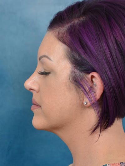 Rhinoplasty Before & After Gallery - Patient 144210401 - Image 2