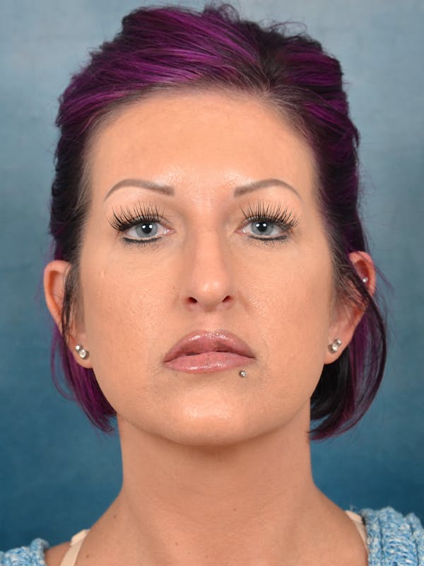 Rhinoplasty Before & After Gallery - Patient 144210401 - Image 3