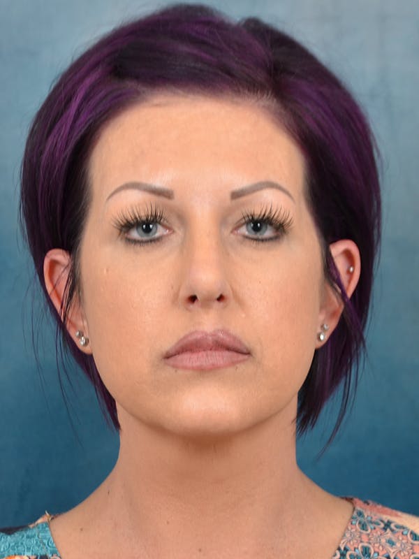 Laser Skin Resurfacing Before & After Gallery - Patient 144211107 - Image 2