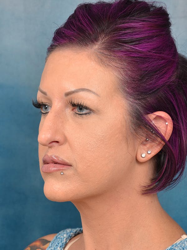 Laser Skin Resurfacing Before & After Gallery - Patient 144211107 - Image 5