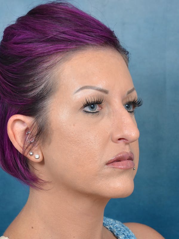 Rhinoplasty Before & After Gallery - Patient 144210401 - Image 7