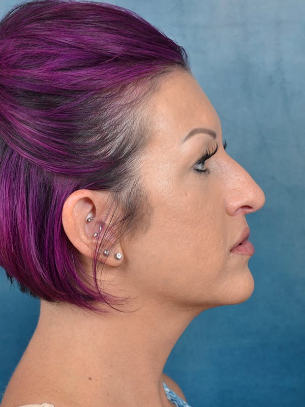 Rhinoplasty Before & After Gallery - Patient 144210401 - Image 9