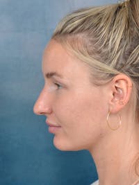 Rhinoplasty Before & After Gallery - Patient 144210402 - Image 1