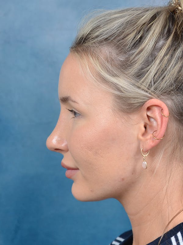 Rhinoplasty Before & After Gallery - Patient 144210402 - Image 2