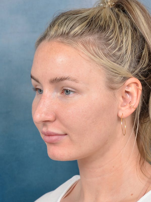 Rhinoplasty Before & After Gallery - Patient 144210402 - Image 5