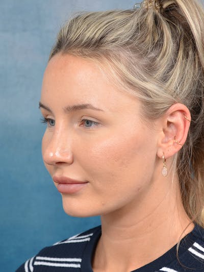 Rhinoplasty Before & After Gallery - Patient 144210402 - Image 6