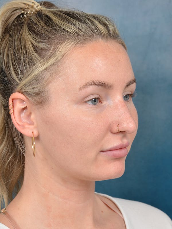 Rhinoplasty Before & After Gallery - Patient 144210402 - Image 7