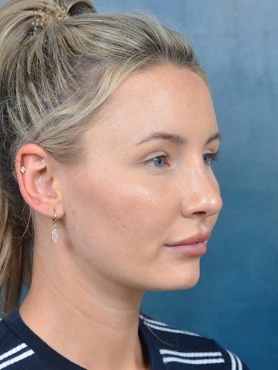 Rhinoplasty Before & After Gallery - Patient 144210402 - Image 8