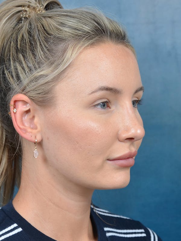 Rhinoplasty Before & After Gallery - Patient 144210402 - Image 8