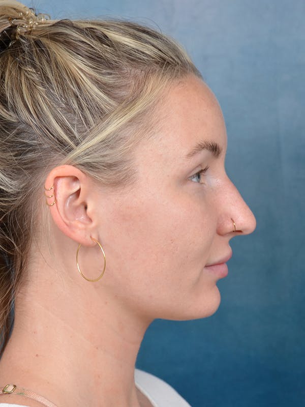 Rhinoplasty Before & After Gallery - Patient 144210402 - Image 9
