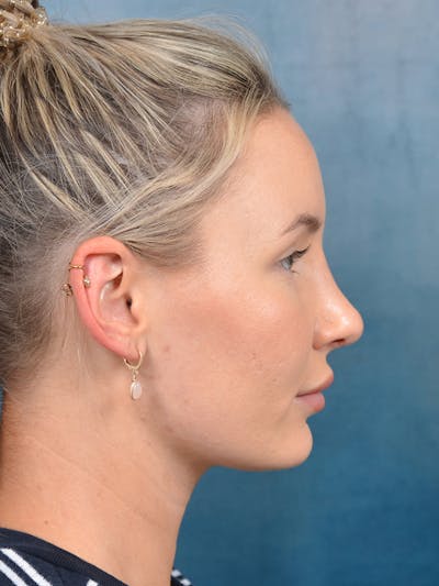 Rhinoplasty Before & After Gallery - Patient 144210402 - Image 10