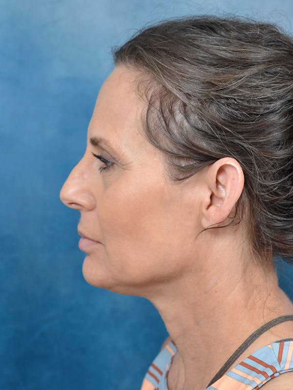 Deep Plane Facelift Before & After Gallery - Patient 144210443 - Image 5