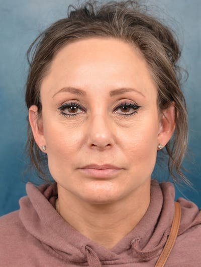 Brow Lift Before & After Gallery - Patient 144210453 - Image 2