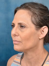 Deep Plane Facelift Before & After Gallery - Patient 144210443 - Image 1