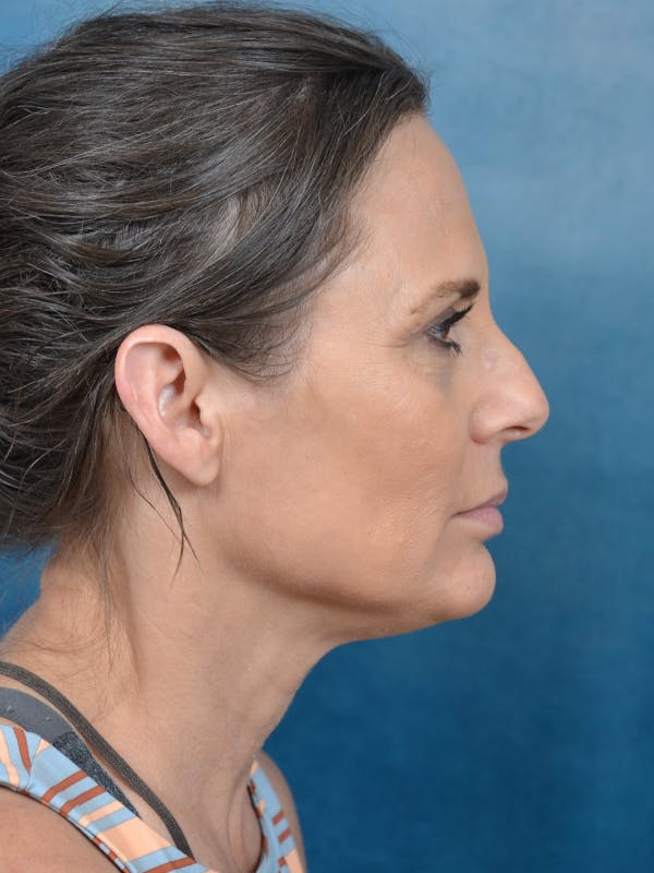 Rhinoplasty Before & After Gallery - Patient 144210439 - Image 9