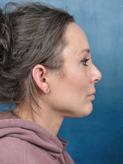 Rhinoplasty Before & After Gallery - Patient 144210439 - Image 10