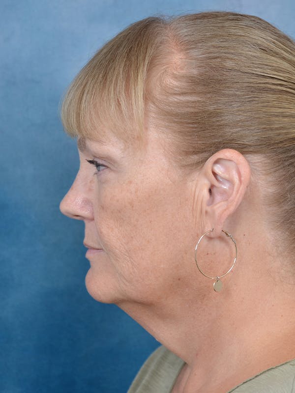 Laser Skin Resurfacing Before & After Gallery - Patient 144210472 - Image 3