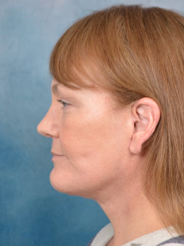 Deep Plane Facelift Before & After Gallery - Patient 144210466 - Image 4