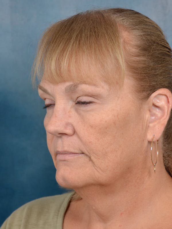 Deep Plane Facelift Before & After Gallery - Patient 144210466 - Image 1