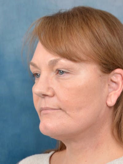 Deep Plane Facelift Before & After Gallery - Patient 144210466 - Image 2