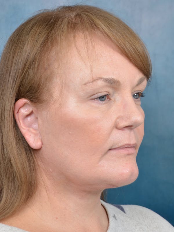 Laser Skin Resurfacing Before & After Gallery - Patient 144210472 - Image 8