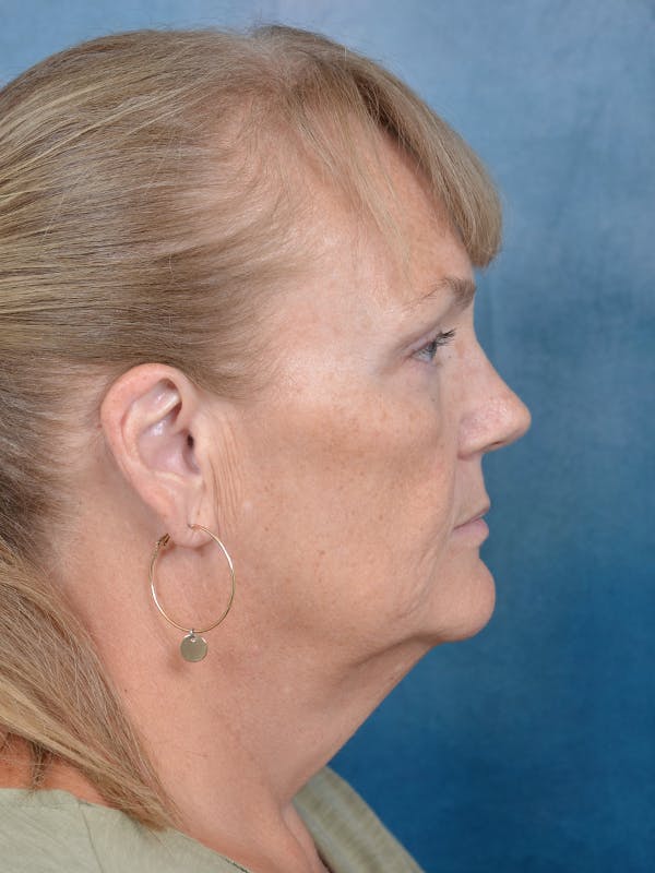 Deep Plane Facelift Before & After Gallery - Patient 144210466 - Image 9