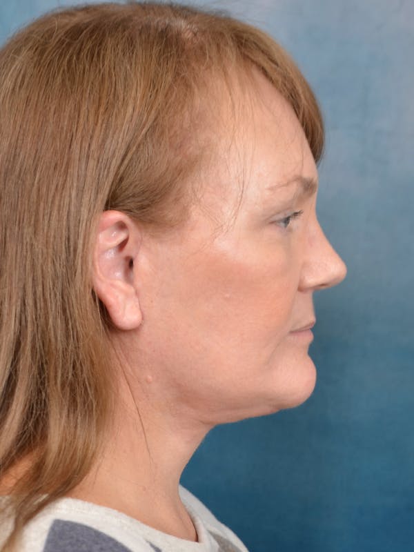 Laser Skin Resurfacing Before & After Gallery - Patient 144210472 - Image 10