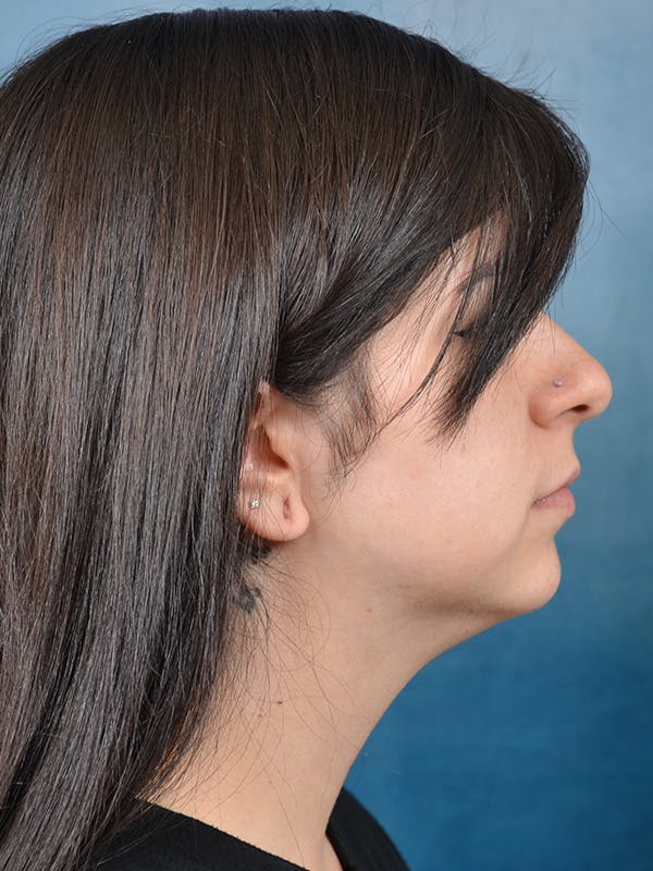 Deep Neck Lift Before & After Gallery - Patient 146149866 - Image 5