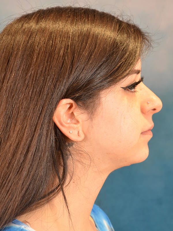 Deep Neck Lift Before & After Gallery - Patient 146149866 - Image 6
