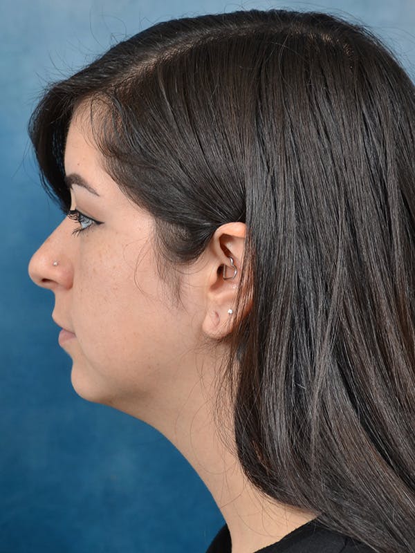 Deep Neck Lift Before & After Gallery - Patient 146149866 - Image 9
