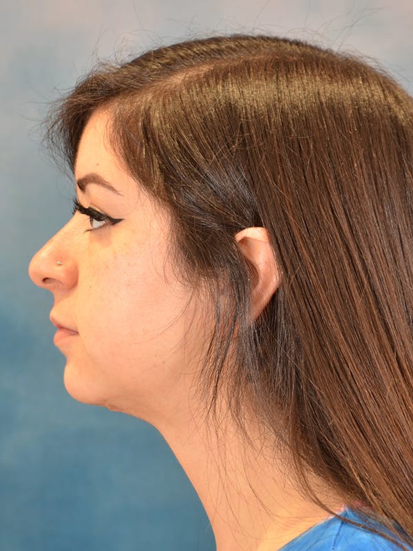 Deep Neck Lift Before & After Gallery - Patient 146149866 - Image 10