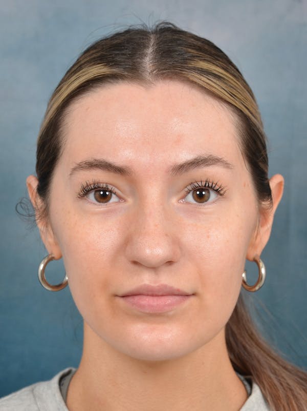 Rhinoplasty Before & After Gallery - Patient 146149881 - Image 3